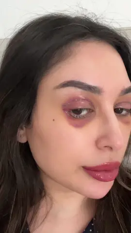 واخيراً سويتها 😍 عملية قص الجفون #blepharoplsty  #upperblepharopasty  #تجميل  #تجميل_الوجه  #سـالفة_ميك_أب 