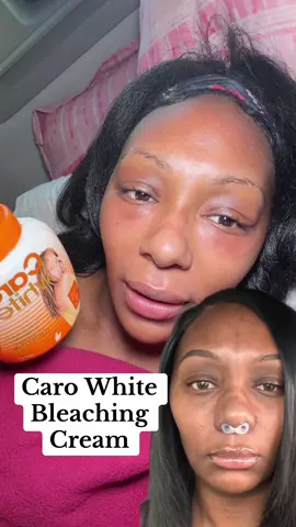 It’s completely normal to see red spots after using Caro white. It will go away after a day or 2. #carowhite #bleachingcream #hyerpigmentation 