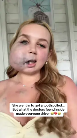 😭😭💔 #teeth #wisdom #women #boyfriend #girls 