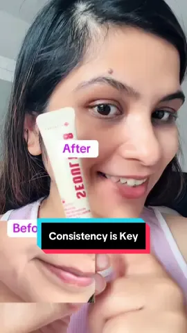 Consistency is Key 😍😍 with SEOUL 1988 Advanced Shot : Retinal Liposome 12% + Black Rice @KSECRET GLOBAL @ksecret_influencer  #GLOWSHOTCHALLENGE #KSECRET #seoul1988 #hyperpigmentation #darkspots
