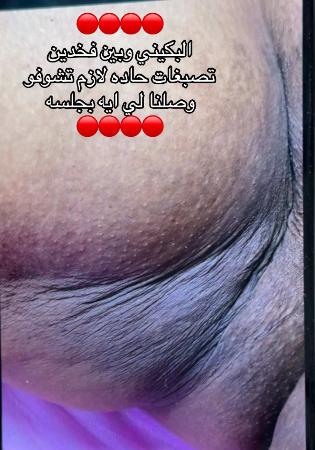 تصبغات بكيني حاده هنا في الفديو هتشوفي اقوي نتيجه وتغير في البكيني من جلسه واحده كاموفلاج شوفي واسمعي ريفيو العميله #كاموفلاج #تفتيح_بكيني #تفتيح #تصبغات #الشعب_الصيني_ماله_حل😂😂 