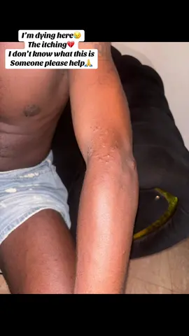 Can someone please help on what to do, I’m tired of the itchy 😥😭 Most especially at midnight  #doctor #dermatologist #fyp #skininfection 