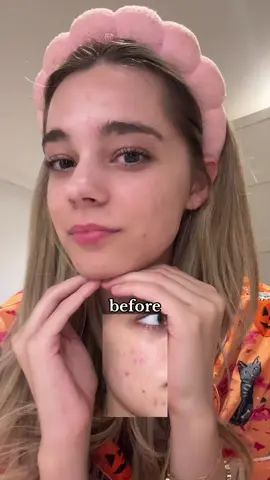 my acne safe cleanse routine! 💚🫧 #arenciapartner #acne #ricemochicleanser #mochicleansingoil #arenciacleansingoil  @Arencia 