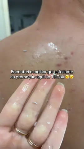#acne #gelesfoliante #esfoliante #pelesaudavel #fyp 