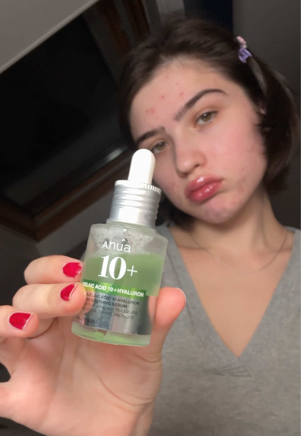 Last week was so stressful… now my skin is paying the price 😭😭😭 #acnemarks #anuaazelaicacidserum #anuaambassador #acnescars #fyp @anua_global 