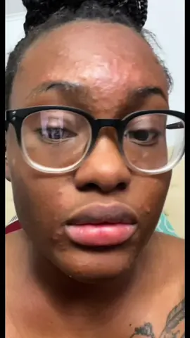 Opéllis was born out of my own struggle. For years, I battled acne and scars that made me feel less than beautiful. I tried it all—top luxury brands, dermatologist prescriptions, and small-batch skincare. Nothing worked. Until I decided to create something myself. After years of research, testing, and perfecting formulas, I discovered a natural solution that finally gave me my skin back. For the past three years, l've lived acne-free-and now, I'm sharing Opéllis with the world. Because everyone deserves skin they can feel confident in.