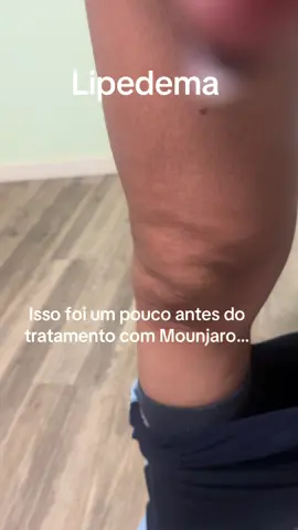 Teve um dia que eu olhei pras minhas pernas e pensei: não dá mais pra ignorar. O inchaço, a dor, o peso… parecia que meu corpo estava pedindo socorro. E ali vi que lipedema não é só estético, não é drama, não é frescura. É uma condição que inflama, limita, cansa o físico e mexe direto na cabeça. Nesse vídeo eu estava bem inflamada, desconfortável, insegura. Mas foi exatamente assim que começou a minha virada. Foi o dia em que eu entendi que não dava pra continuar empurrando com a barriga e escolhi me tratar de verdade. Escolhi cuidar de mim, respeitar meus limites, ajustar alimentação, treinar, beber água, tomar meus remédios e acompanhar com médicos. Escolhi me ouvir de verdade. Essa decisão mudou tudo. Não porque o lipedema desaparece, porque ele não desaparece, mas porque eu parei de lutar contra o meu corpo e comecei a lutar por ele. Se você também vive isso, saiba que não tem vergonha em pedir ajuda, em começar do zero, em tropeçar e recomeçar. O importante é não abandonar você mesma. Seguimos. Um dia de cada vez. E cada passo faz diferença. 🩵 #lipedema #mounjaro #rotina 