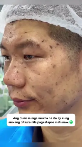 🥰🤩Ang SHEEureka ay dahan-dahang nag-exfoliate, na maaaring mapabuti ang mga problema sa balat. Hindi mo kailangang mag-alala tungkol sa mamantika na balat, akumulasyon ng mga blackheads, 🥰❤️👍🏻at makeup. Ang mga sangkap ay banayad at ligtas. Huwag mag-alala tungkol sa sensitibong balat. Maaari mong gamitin ito nang may kumpiyansa.😘 #fyp #gel #skincare #exfoliation #sheeureka PH5859