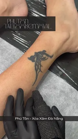 Xoá xăm chuyên nghiệp Đà Nẵng #xoaxam #xoahinhxam #xoaxamdanang 