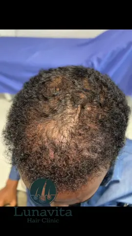 2 Bilood Hair Transformation ✨ Laser • Exosome • PRP • GFC • Microneedling • Deep Hair Washing 🔥 Daadashada jooji 🌱 Timo cusub bilow 💆🏽‍♀️ Timahaaga xooji 📈 Natiijo muuqata 60 maalmood gudahood DM fariin — Boosaska waa kooban. 💛 Ama 252617166325 #lunavitahairclinic #microneedling #hairtreatment #lowlazerlighttherapy #besthairtransplant 
