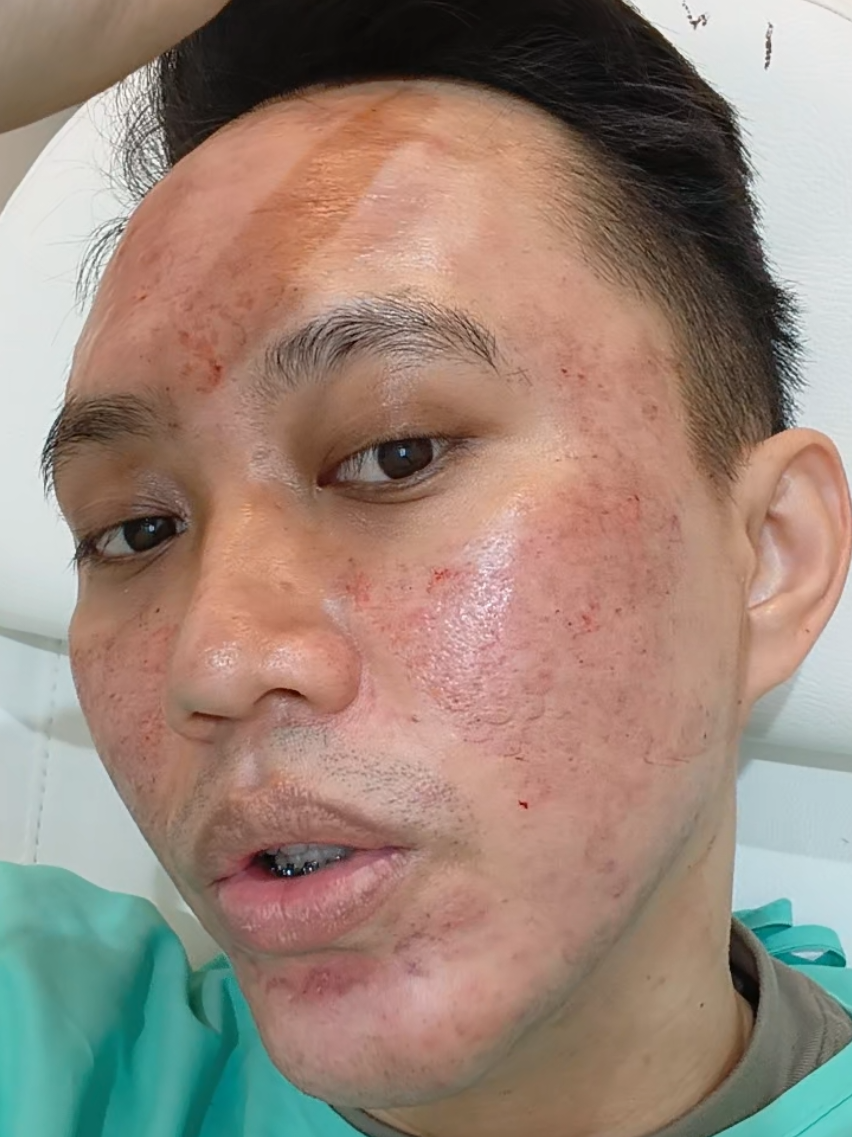 Membalas @kenzharist  enak bgt treatmentnya GA ADA RASA SAKIT SAMA SEKALI love you @cellscience #poresurgery #scar #bopeng 