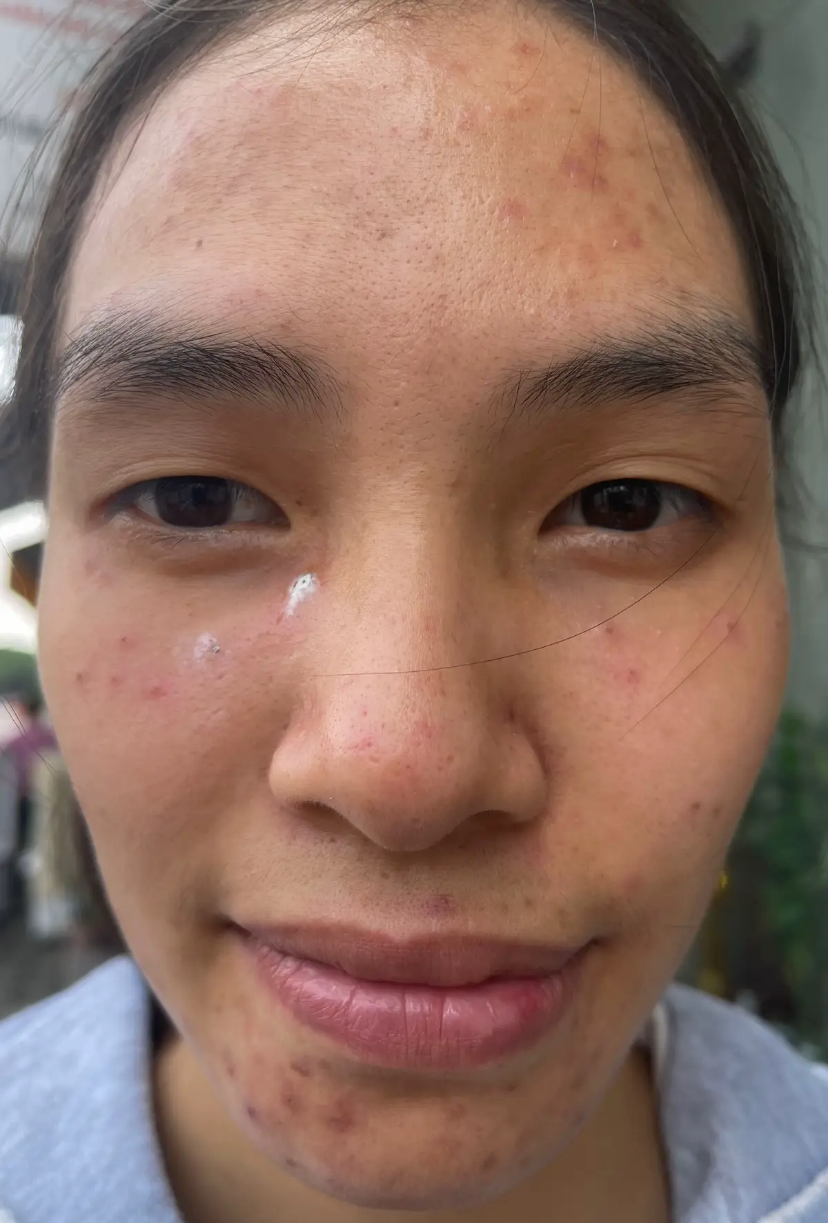 Kết quả khách dtri Mụn bên nhà e nha🥰#chamsocda #damun #nanmun #dieutrimun #xuhuong 