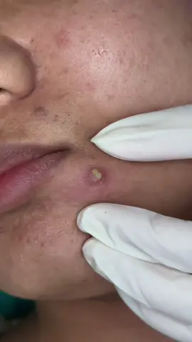 Dĩ nhiên rồi phải lấy nhân ra thôi #trimungovaphieuqua #haantrimungovap #nanmungovap 