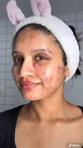 ဝက်ခြံအမျိုးမျိုးကိုကုသပေးနိုင်တဲ့joy#joyproductsfounder #joy #JoyAcneCream #AcneTreatment #ဝက်ခြံပျောက်ဆေး 