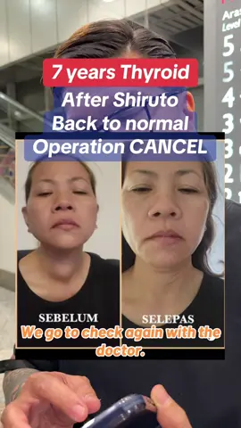 Uncle Ken’s wife had thyroid for 7 years, after took 6 sachets Shiruto everyday for 3 weeks, amazingly the report shown back to normal and cancelled the scheduled operation. #thyroid #goiter #shiruto #autoimmune #fyp 