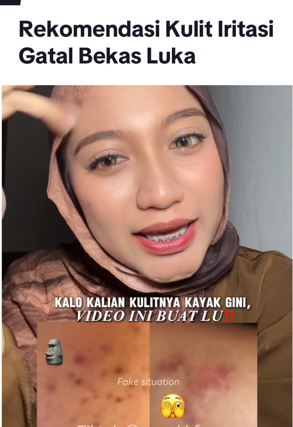 Membalas @𝐧𝐚𝐮𝐫𝐚🌻 jangan sampe malu perkara banyak bekas luka 😭😭 #BekasLuka #Ruam #creambekasluka 