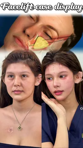 #面部提升 #提升苹果肌 #法令纹 #松弛下垂 #抗衰 #拉皮 #调整脸型 #筋膜提升 #Counterattack #facelift 