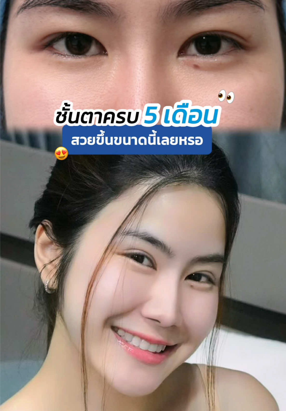 #รีวิวตาสองชั้น ครบ 5 เดือน 👀 ต้องสวยขนาดนี้เลยหรอ 💖💖 #skyclinic #หมอสกาย #ทําตาที่ไหนดี #จักษุแพทย์ 