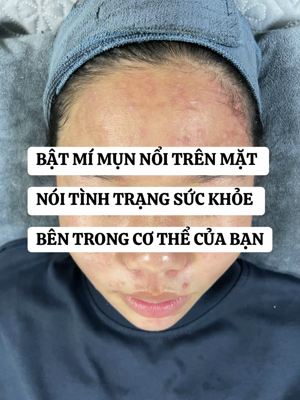 #thuykieubeauty8 #mụn #xuhuong #skincare #chamda 