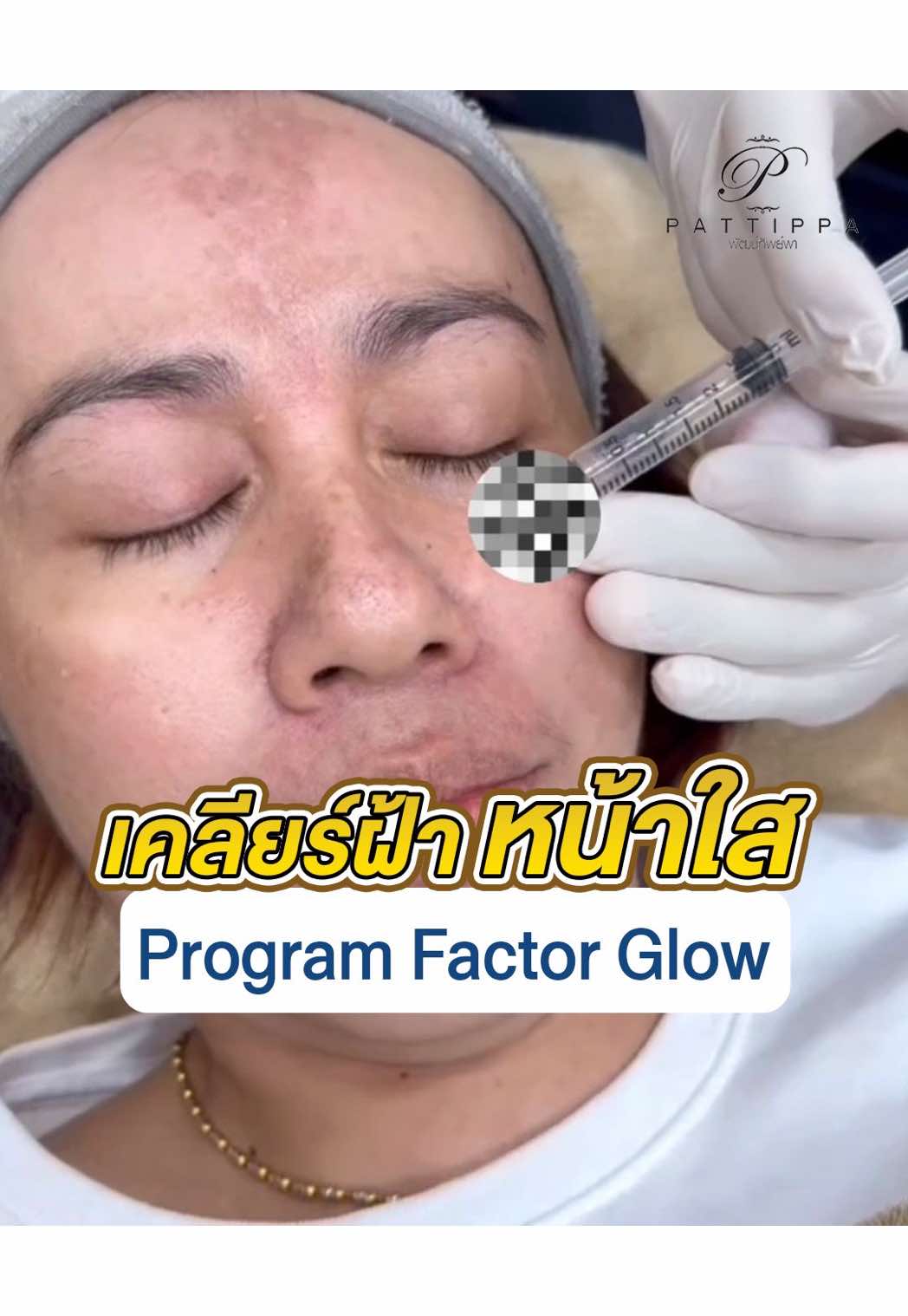 เจอหมอ 5 ครั้ง ได้แบบนี้ #รักษาฝ้ากระจุดด่างดํา #มาร์คหน้าใส #ผิวแพ้ง่ายใช้ได้ #มอยเจอร์ไรเซอร์ #เรื่องผิวหน้าต้องpattippaclinic  @หมอเต้หมอเธีย เคลียร์เรื่องผิว  @หมอเต้หมอเธีย เคลียร์เรื่องผิว  @หมอเต้หมอเธีย เคลียร์เรื่องผิว 
