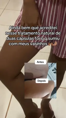 Vivendo tudo que desejava #varizesevasinhos #varizessemcirurgia 