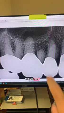 Another block of concrete! #dentists #dentalstudent #rootcanal #dentalhygienist #dentalofficelife 