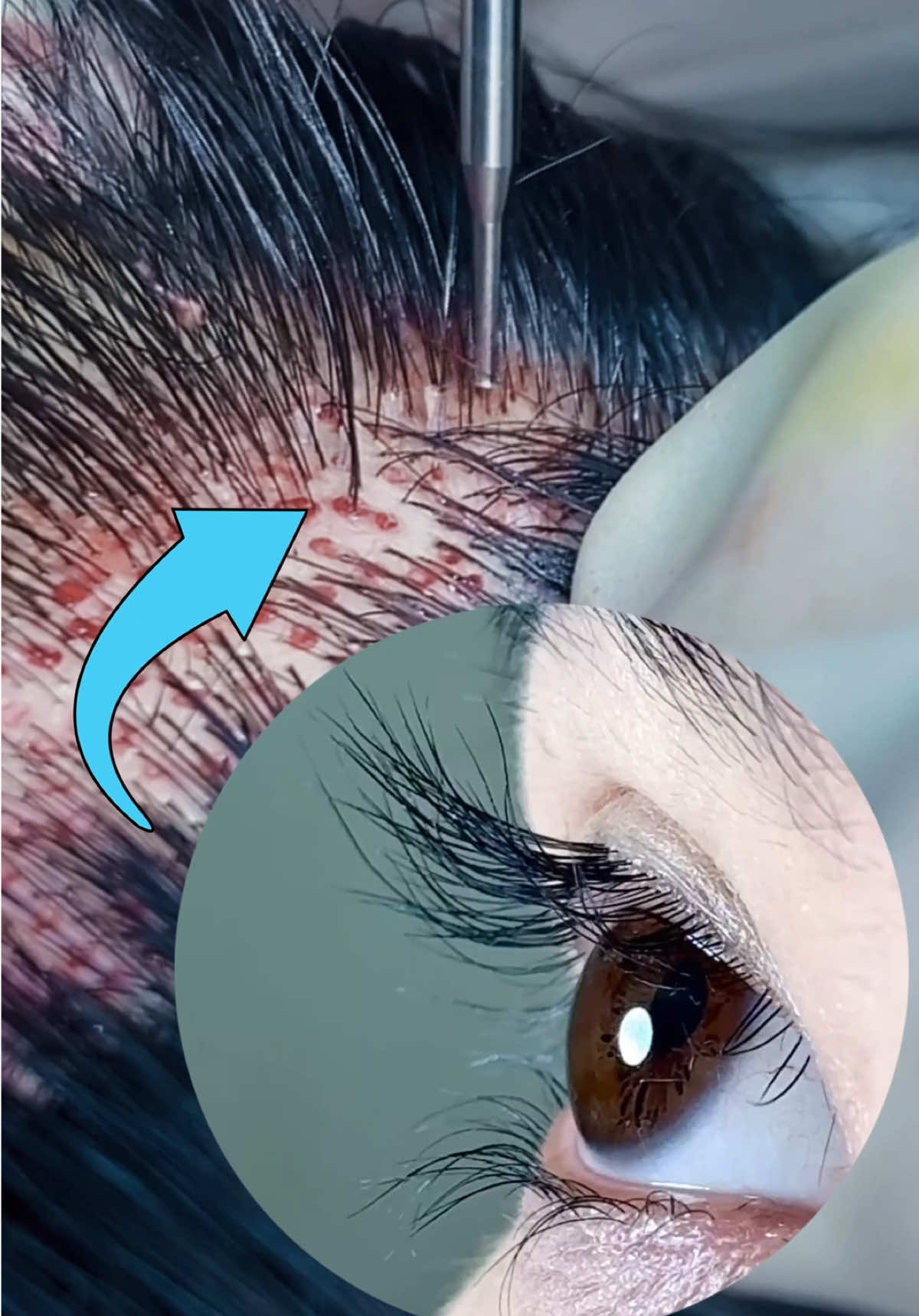 Eyebrows transplant and eyelashes transplant🥰🥰🥰#eyebrowtransplantation #eyebrowtrimming #beauty #植眉 #眉毛种植 