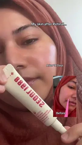 My skin after retinal 🥺 • KSECRET SEOUL 1988 ADVANCED SHOT: RETINAL LIPOSOME 12% + BLACK RICE • retinal actually works 11 times faster than traditional retinol • 🖤 also has 12% Retinal Liposome promotes skin cell turnover to help with slow-aging = protects your skin •  It has creamy texture • And this KSECRET retinal has a gentle formula • ‼️ apply on DRY skin & mature skin only at night •  • I had some breakouts and enlarged pores & wrinkles like smile lines . I am 33 & • I've actually built up my tolerance using retinal so I can use it every night • in the first week or two you should just use it twice a week • Day 5 I saw improvements to my skin texture but I still had some breakouts • Day 14 my pores & smile lines were a lot less visible &  • my skin was soft and my dark spots were completely gone • ✨ also my skin looks glowy & smoother • honestly I'm just so happy with discovering retinal shot. @KSECRET GLOBAL #GLOWSHOTCHALLENGE #KSECRET #seoul1988 #hyperpigmentation #darkspots 