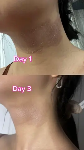 Is this worth $300?😏😏 Watch until the end. Purple Rescue Drops in 48 hours! Set your alarms⏰  #naturalskincare #acnetreatment #eczema #dryskin #skintransformation 
