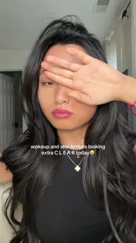 goodmorning❤️ skin update! #acne #acneproneskin #acnejourney #pimples 