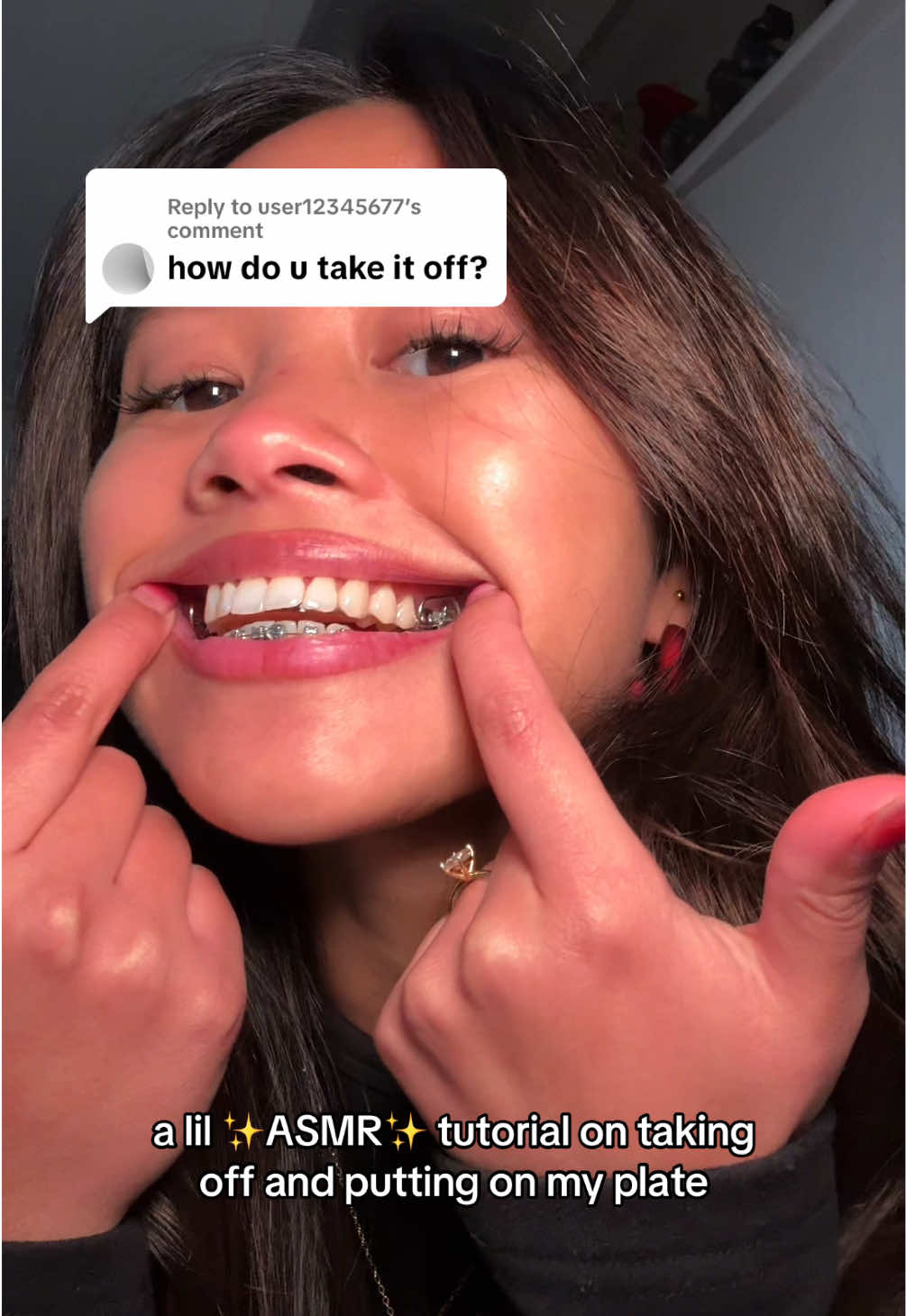 Replying to @user12345677  part 6 | since the last post included explanations during the video, i wanted to create a silent and quick tutorial on how to take off the plate for those who want to-the-point videos! it just so happens that this video happens to be a little bit asmr-like 🫣🤭 btw, im usually slightly more gentle with my plate!! if you guys have any questions, feel free to ask it down below 😊 #braces #bracesjourney #teethcare #teethtok #bracescheck 