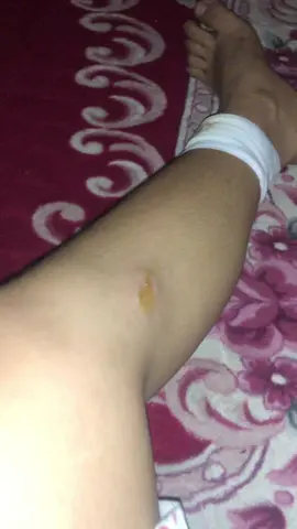 #ជើងខ្ញុំខ្ទេចអស់ហើយដួលម៉ូតូ។😞💔👋🥀🏍️