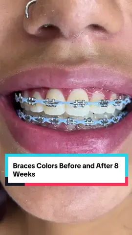 #bracescolors #braces #orthodontist #katytx