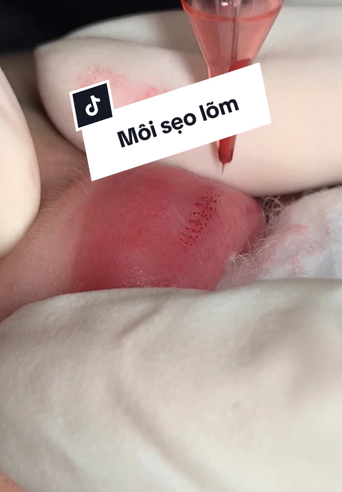 Lướt trên vết sẹo lõm, để đi môi sẹo bám màu thì mn nên đi bằng đầu kim, chậm rãi và có độ “phập” nhẹ. Nếu ko sẽ rất khó vào màu vùng sẹo. Tuy nhiên cần căn lực tay chuẩn để môi ko bị chảy siro nhiều nhen👌 #elizabethacademy #Sunshinelips #lamdep #xuhuong #phunmoitunhien #trend 