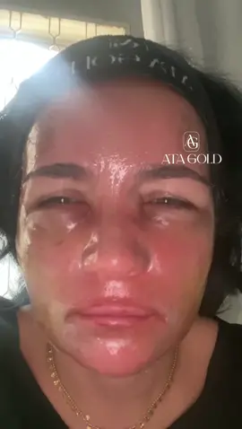 Quer entender melhor o processo de crostas do ATA GOLD? Comente “CROSTAS” que eu te explico tudo! #peeling #chemicalpeel #BeautyTok #skintok #peelingserum 