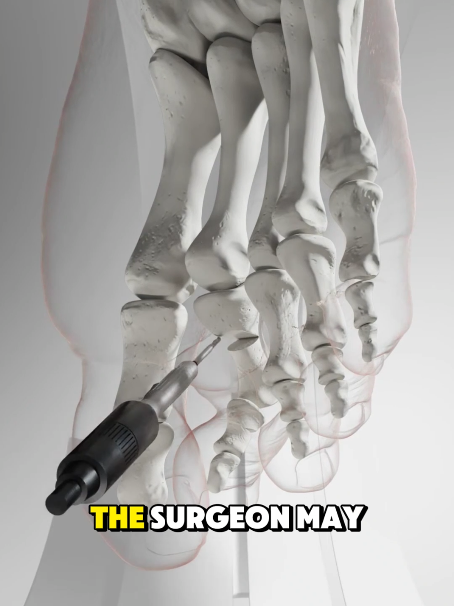 Ever Wondered How Hammer Toe Repair Surgery Explained - Medical 3d Animation. #hammertoe #footsurgery #orthopedicsurgery #toerepair #podiatry 