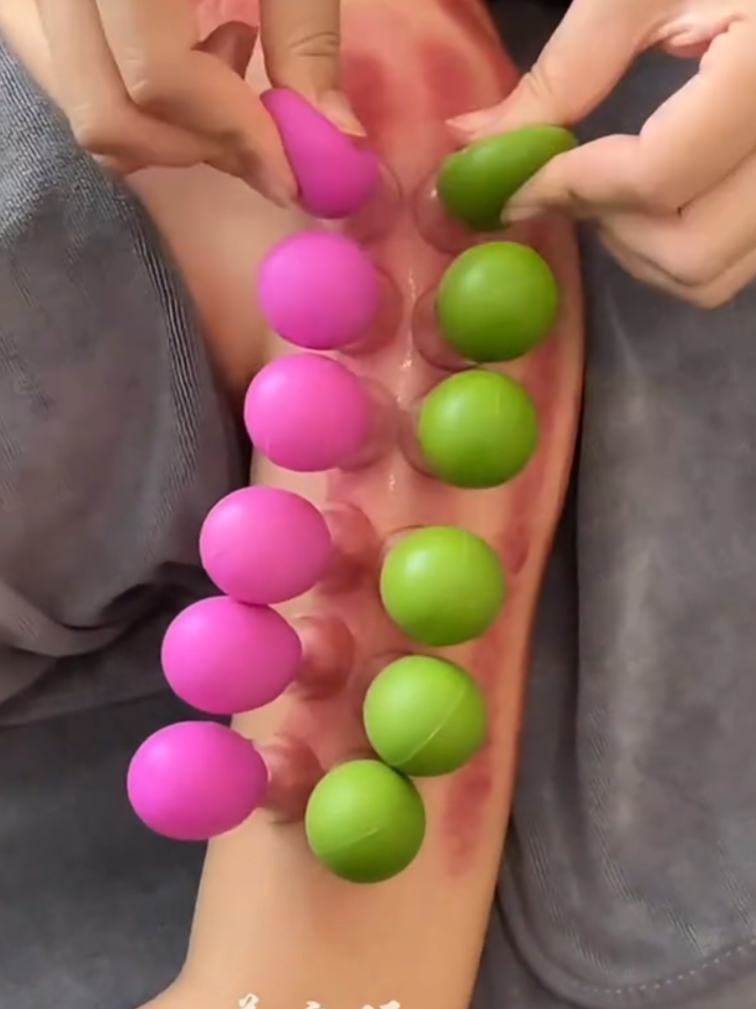 Cốc giác hơi cạo gió mini không đau #cocgiachou #caogio #spa #suckhoe 