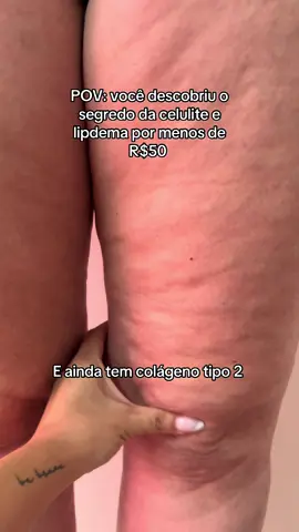 Curcumina em cápsulas  tem  Ação Anti-inflamatóri4: O lipedema é caracterizado por inflamaçã00 crônica no tecido adipos0. A curcumina pode ajuda44r  a atenuar essa resposta inflamatóri4, inibind0 mediadores inflamatóri00 #lipedema #celulite 