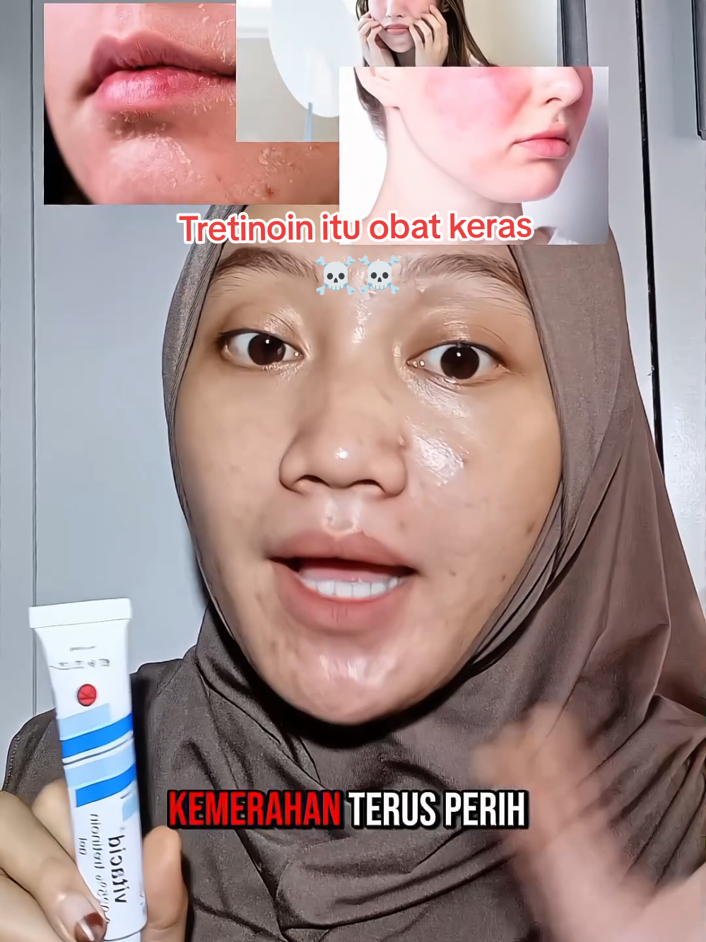Masih mau fomo sama Tretinoin?? tergolong obat keras dan harus resep dokter 💕 emang hasilnya Tretinoin bagus sayy💕 #tretinoin #vitacid #acnefighter #acneskincare #sitta🦩 