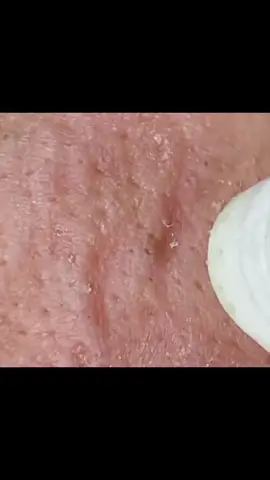 #SatisfyingVideo #BlackheadRemoval #PimplePopping #SkincareASMR #deepcleaning 
