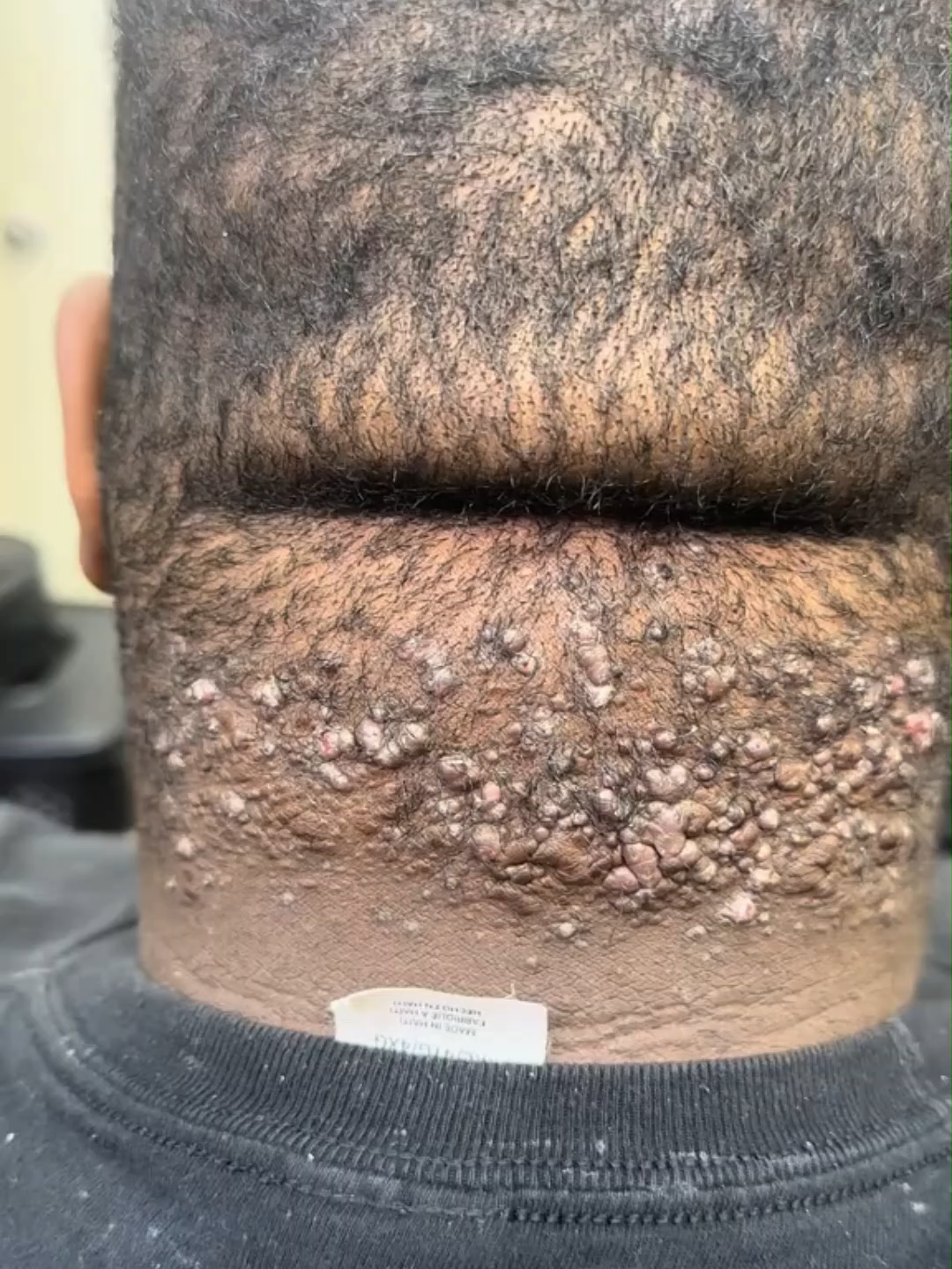 How Lifestyle and Diet Affect AKN Scars Meta description: Diet and lifestyle play a big role in AKN recovery — here’s how to support healing. Inflammation doesn’t only happen on the surface — it starts from within. Processed foods, excess sugar, and dairy can worsen AKN. For better healing, eat anti-inflammatory foods rich in Vitamin C, Zinc, and Omega-3s.  Kelo Scar Cream complements this by soothing inflamed areas and improving skin regeneration. Together, good nutrition and consistent care deliver visible results within weeks. ⚡ From Dec 19–30, enjoy 25% OFF during our Black Friday Sale. #keloscar #bumps #akntreatment #acnescarsremoval #keloidscar #folliculitistreatment #keloscarabera #removescar #keloabera #keloidtreatment #keloid #customerreview #akn #Durag #blackfriday #blackfridaydeals #blackfridaysale #blackfridayearlydeals #MensGrooming #DermatologistApproved