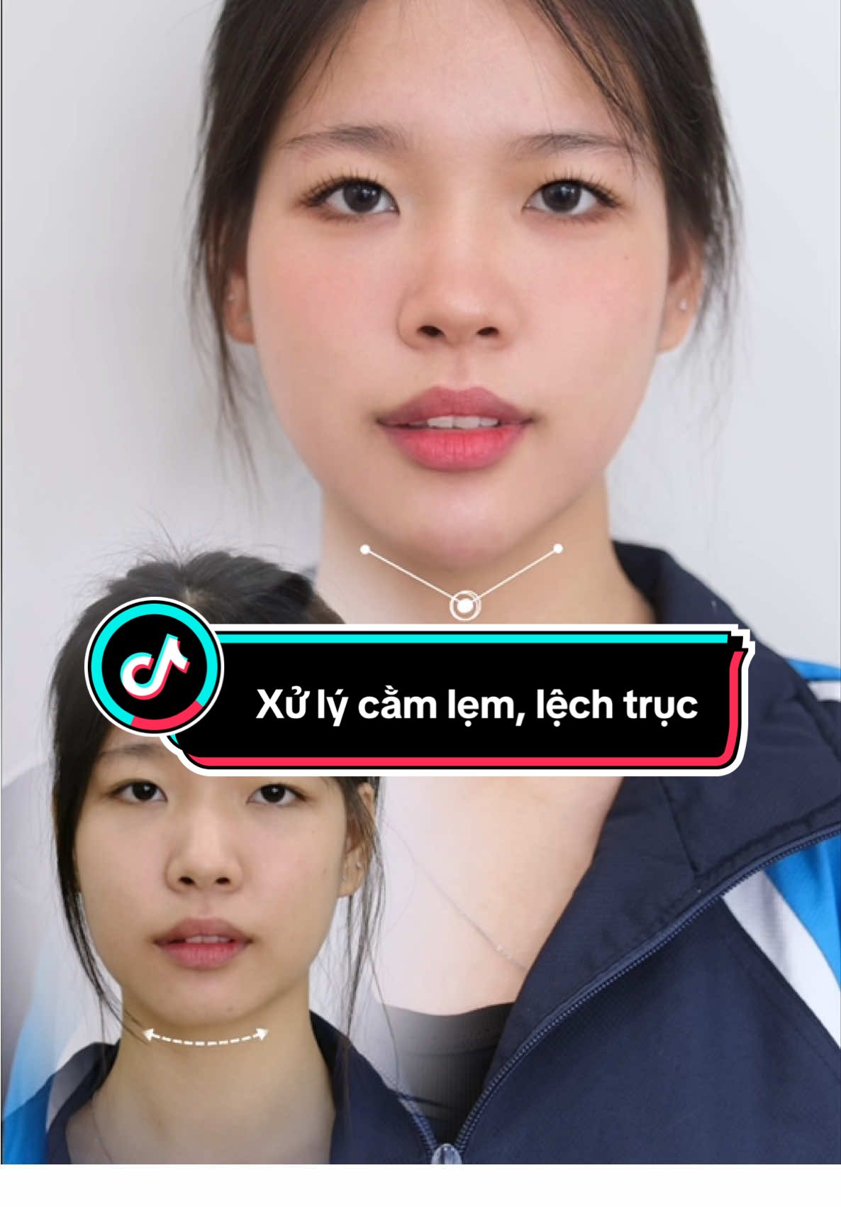 Chủ vài điểm nhỏ cũng khiến gương mặt trở nên hài hoà và thanh thoát hơn mà không ohair ai cũng biết 🥰  #cằmvline #phamhailinh #tiemcam #daytiemfiller #cằm 