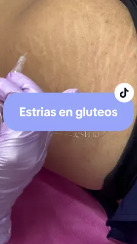 Paso a paso de la eliminación de las estrías en glúteos #estriasbrancas #removestretchmarks 