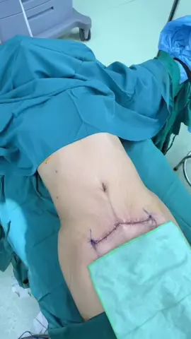 Vừa hoàn thành ca hút mỡ, cắt da mini cho chị khách Việt Kiều. #hutmo #lamdep #xuhuongtiktok 