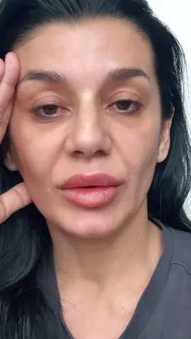 #dermarolleruygulaması #elastina #riduri #colagen 