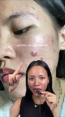 Hindi na magtatagal ang pimples mo! 🤫 This Y.O.U AcnePlus Spot Care Pro Serum is my overnight healing hack. Super effective para sa active breakouts at calming redness. Must-have for clear skin! Dries pimples fast!  #BudolFinds #AcnePlusSpotCare #SpotTreatment #SkincareTok 