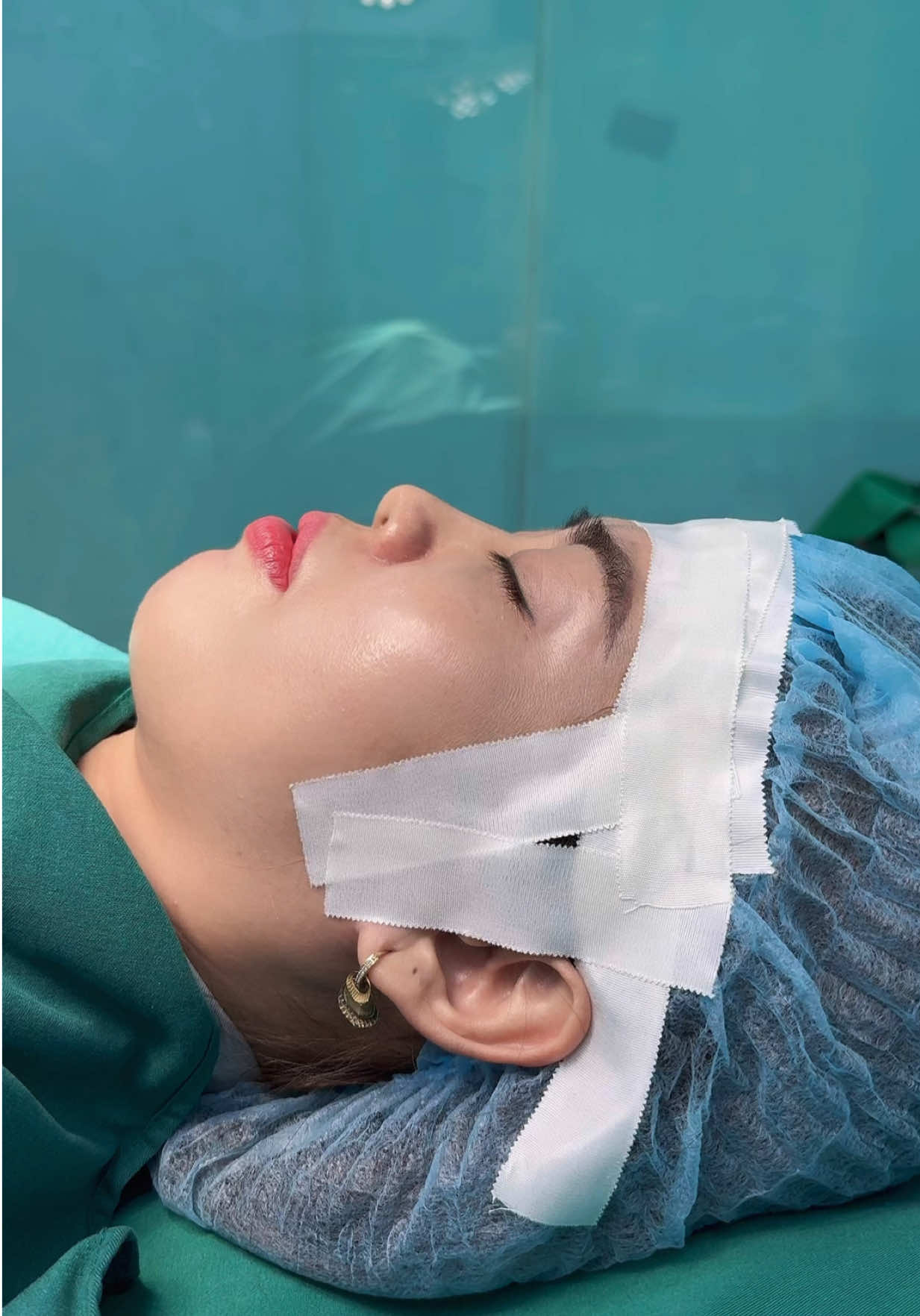 Sửa Lại Chiếc Mũi Từng Tiêm filler ..#xuhuong #nangmui #muitrunghoa #muicautruc #suamuihong 