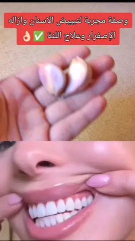 #وصفة مجربة لتبييض الاسنان وازاله الإصفرار وعلاج اللثة ✅#تبييض#-علاج#اللثة#francecouple 