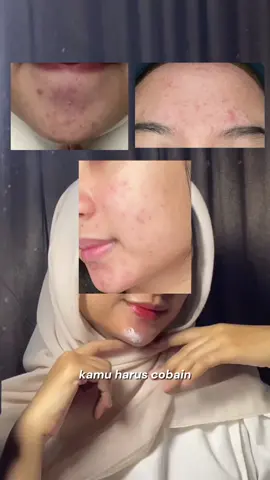 Dulu aku pikir kulitku cuma ‘nggak cocok skincare’. Ternyata cuma butuh yang lebih lembut @La Roche-Posay Indonesia 💆🏻‍♀️ #larocheposay #skinlifechanger #supermoisturizer #cicacovered #cicacoveritall