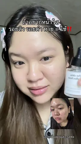 ถ้าอยากหน้าใส รอยสิว รอยดำ หาย = ใช้‼️ #เดอะสกินคอลเล็คชั่น #theskincollection #เซรั่มหน้าใส #ลดรอยสิว #เซรั่มtheskincollection  @นุ่ม‘นะ   𐙚⋆  @นุ่ม‘นะ   𐙚⋆ 
